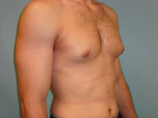 Male Breast Reduction - Gynecomastia