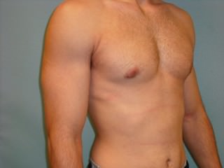 Male Breast Reduction - Gynecomastia