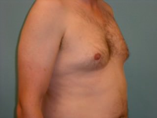 Male Breast Reduction - Gynecomastia