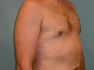 Male Breast Reduction - Gynecomastia