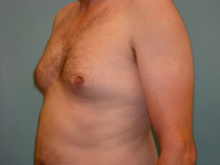 Male Breast Reduction - Gynecomastia