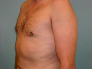 Male Breast Reduction - Gynecomastia