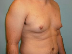 Male Breast Reduction - Gynecomastia