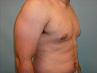 Male Breast Reduction - Gynecomastia