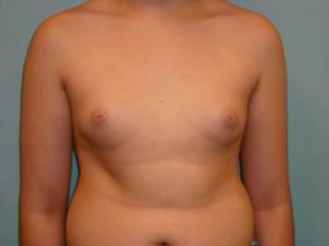 Male Breast Reduction - Gynecomastia