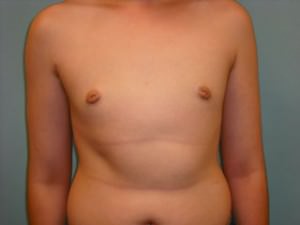 Male Breast Reduction - Gynecomastia