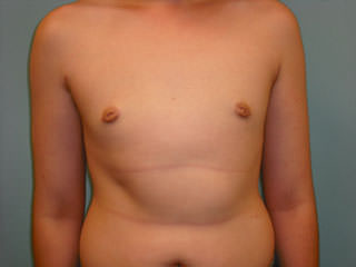 Male Breast Reduction - Gynecomastia