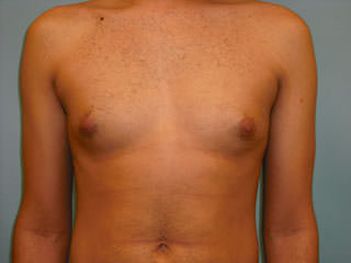 Male Breast Reduction - Gynecomastia