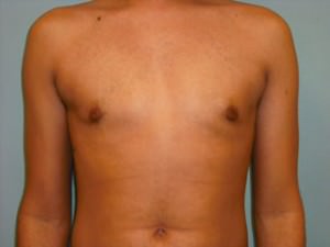 Male Breast Reduction - Gynecomastia