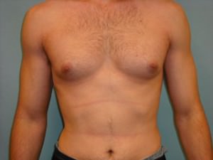 Male Breast Reduction - Gynecomastia