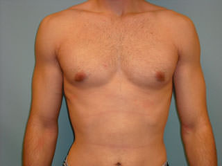 Male Breast Reduction - Gynecomastia