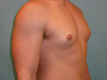 Male Breast Reduction - Gynecomastia