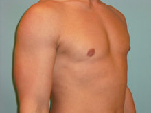 Male Breast Reduction - Gynecomastia