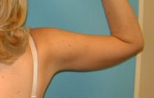 Brachioplasty (Arm Lift)