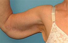 Brachioplasty (Arm Lift)