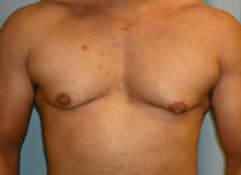 Male Breast Reduction - Gynecomastia