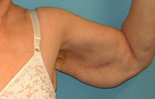 Brachioplasty (Arm Lift)