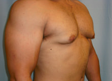 Male Breast Reduction - Gynecomastia