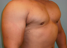 Male Breast Reduction - Gynecomastia