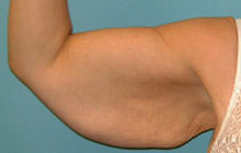 Brachioplasty (Arm Lift)