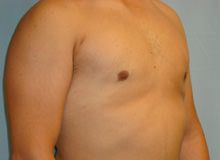 Male Breast Reduction - Gynecomastia