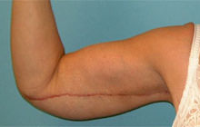 Brachioplasty (Arm Lift)