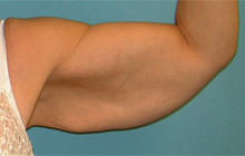 Brachioplasty (Arm Lift)