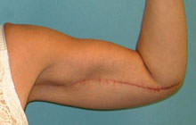 Brachioplasty (Arm Lift)