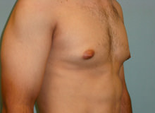 Male Breast Reduction - Gynecomastia