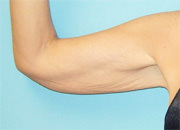 Brachioplasty (Arm Lift)