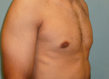 Male Breast Reduction - Gynecomastia