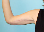 Brachioplasty (Arm Lift)