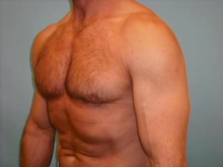 Male Breast Reduction - Gynecomastia