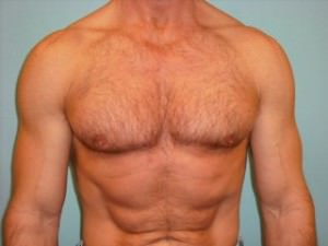 Male Breast Reduction - Gynecomastia