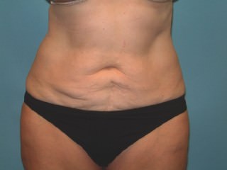 Tummy Tuck