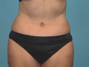 Tummy Tuck