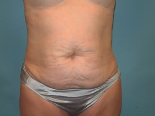 Tummy Tuck