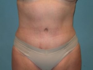 Tummy Tuck