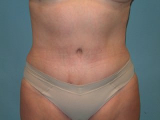 Tummy Tuck