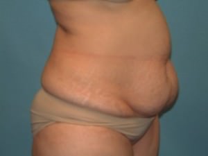 Tummy Tuck