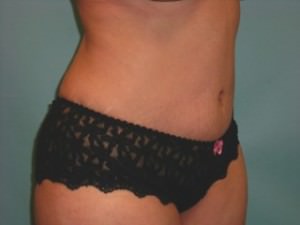 Tummy Tuck