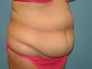 Tummy Tuck