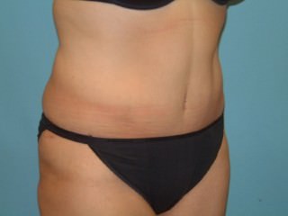 Tummy Tuck