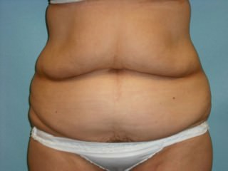 Tummy Tuck