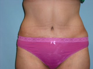 Tummy Tuck