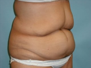 Tummy Tuck