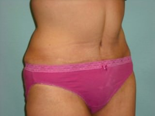 Tummy Tuck