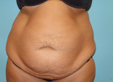 Tummy Tuck