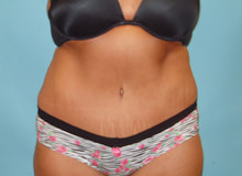 Tummy Tuck