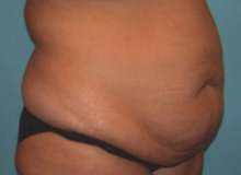 Tummy Tuck